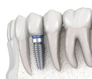 A4 Implant system in San Carlos CA Area