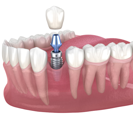 A 3D model of a dental implant and a jaw