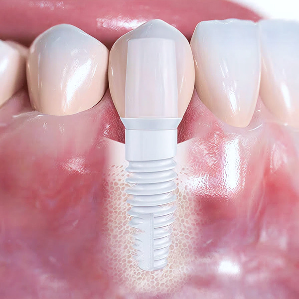 A 3D render of a tooth implant in the jaw