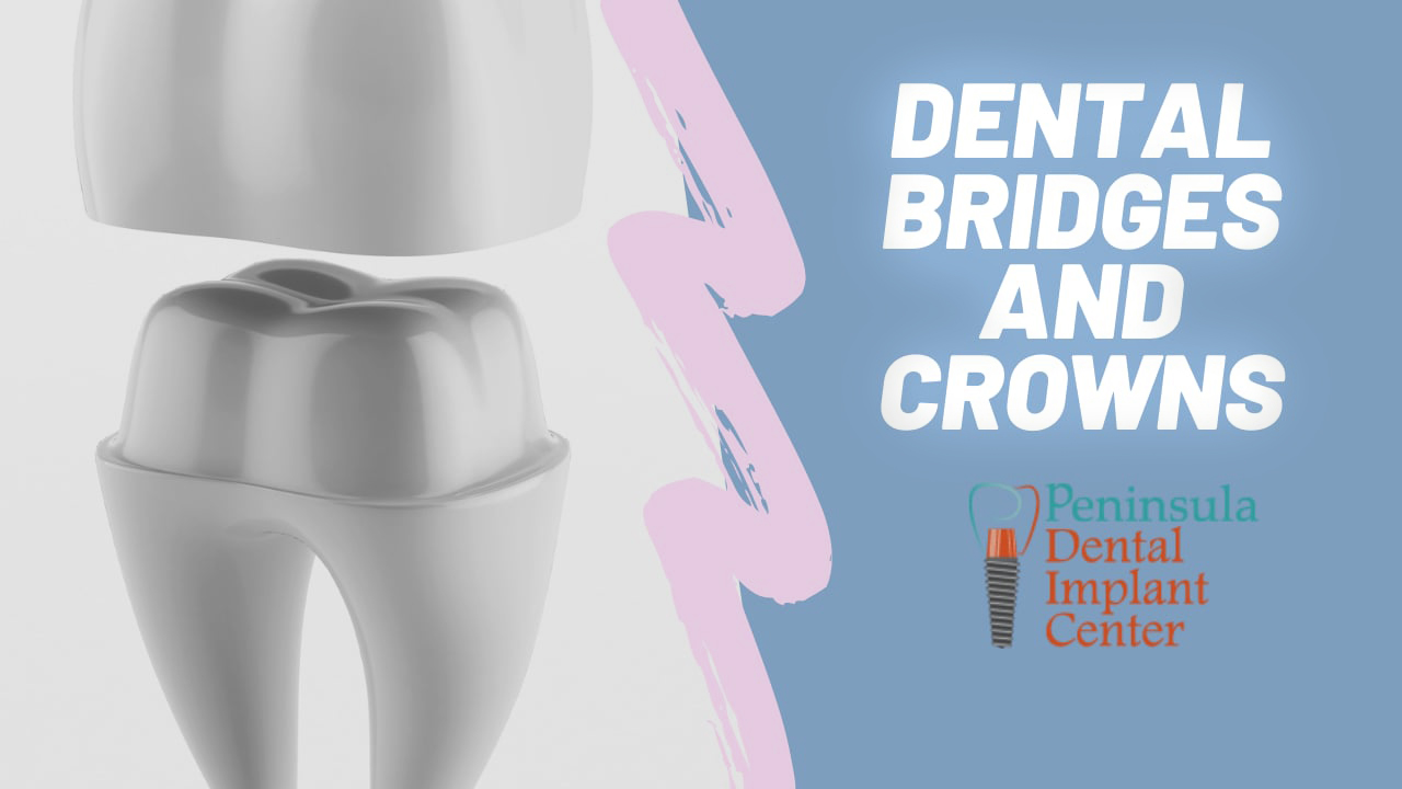 Bridges and Crowns San Carlos - Bridge Treatment - Dental Crowns
